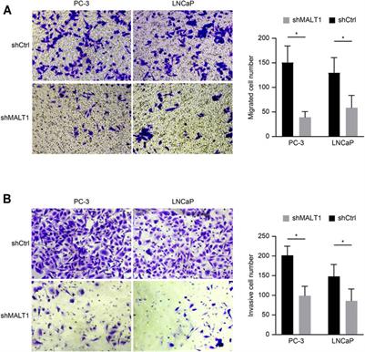 Integrative Analysis of MALT1 as a Potential Therapeutic Target for Prostate Cancer and its Immunological Role in Pan-Cancer